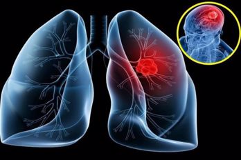 GIẢI ĐÁP: Triệu chứng của ung thư phổi di căn não là gì?